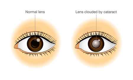 Cataracts Can Sneak Up on You